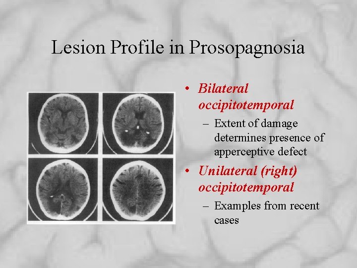 Lesion Profile in Prosopagnosia • Bilateral occipitotemporal – Extent of damage determines presence of