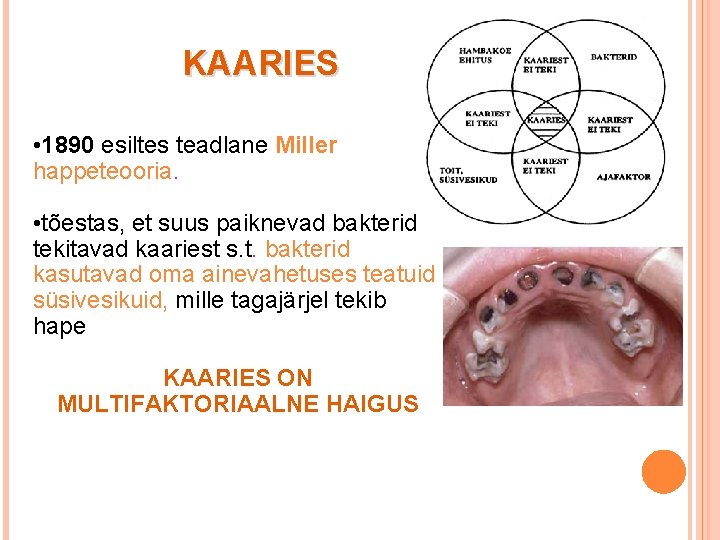 KAARIES • 1890 esiltes teadlane Miller happeteooria. • tõestas, et suus paiknevad bakterid tekitavad