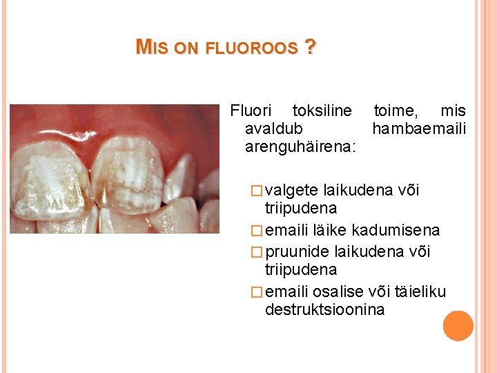 MIS ON FLUOROOS ? Fluori toksiline toime, mis avaldub hambaemaili arenguhäirena: � valgete laikudena