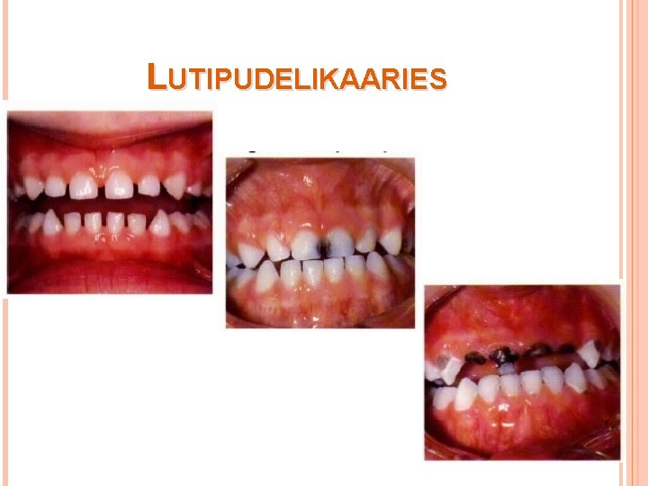 LUTIPUDELIKAARIES 