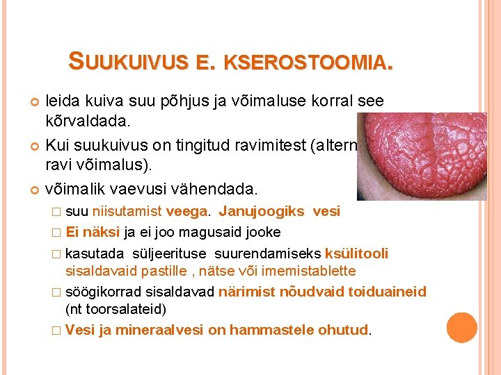 SUUKUIVUS E. KSEROSTOOMIA. leida kuiva suu põhjus ja võimaluse korral see kõrvaldada. Kui suukuivus