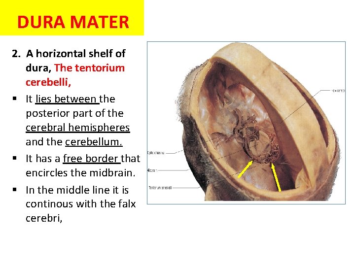 DURA MATER 2. A horizontal shelf of dura, The tentorium cerebelli, § It lies