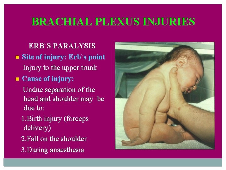 BRACHIAL PLEXUS INJURIES ERB`S PARALYSIS Site of injury: Erb`s point Injury to the upper