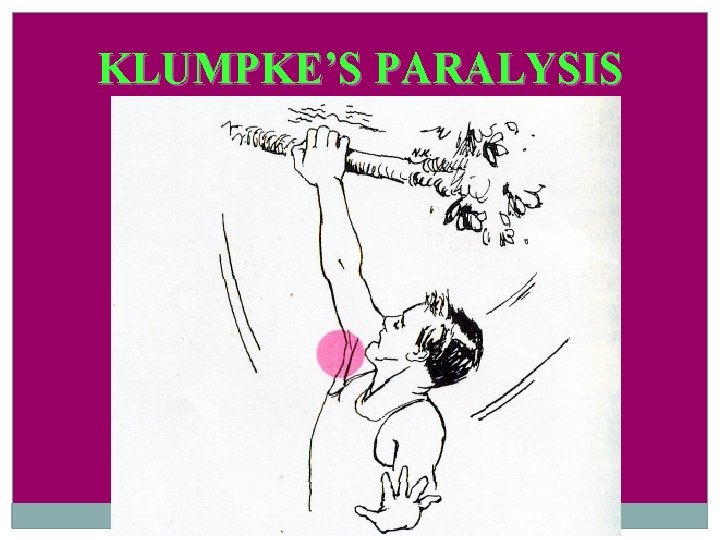 KLUMPKE’S PARALYSIS 