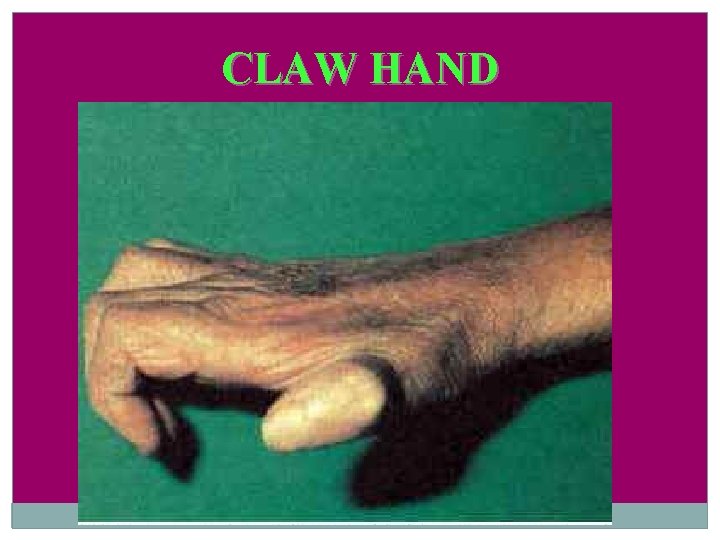 CLAW HAND 