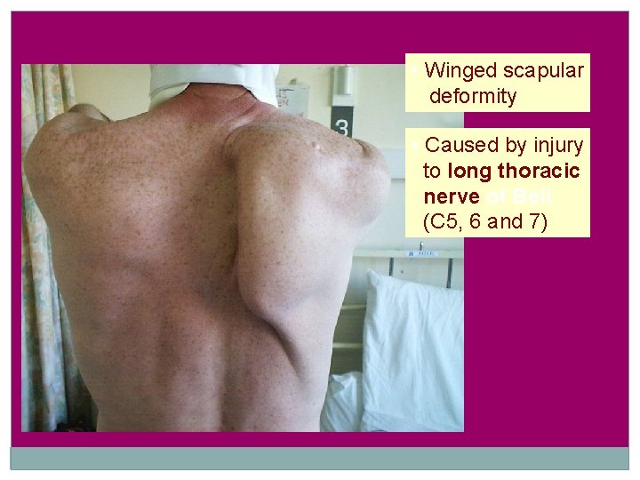  • Winged scapular deformity • Caused by injury to long thoracic nerve of