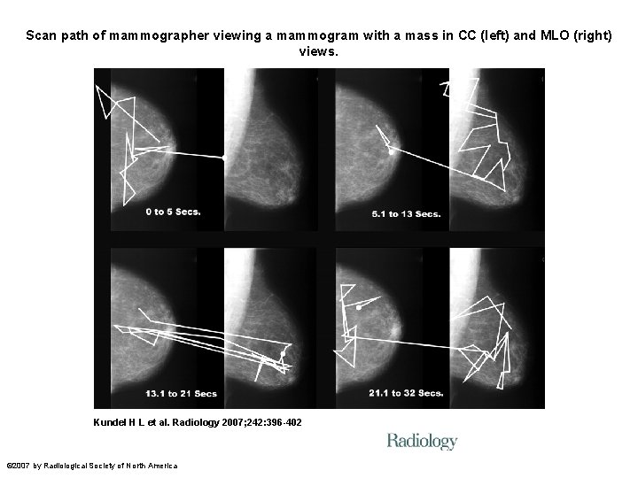 Scan path of mammographer viewing a mammogram with a mass in CC (left) and