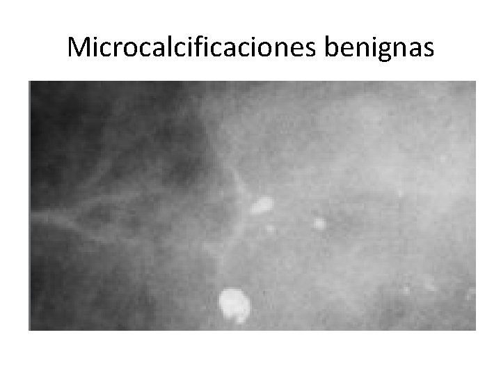 Microcalcificaciones benignas 