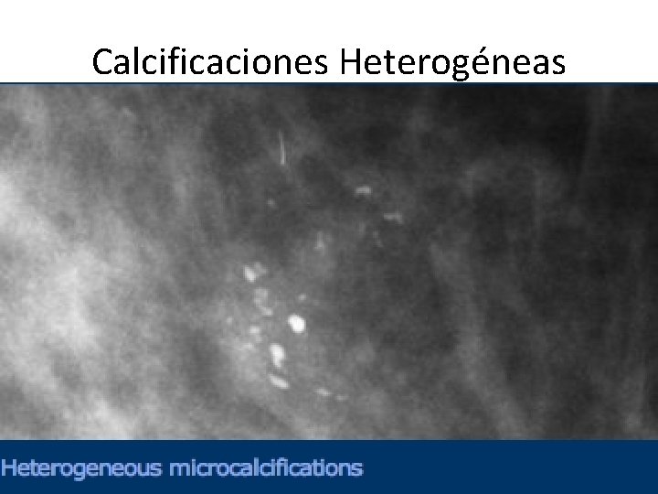 Calcificaciones Heterogéneas 