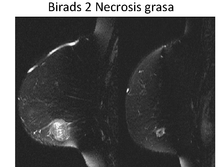 Birads 2 Necrosis grasa 