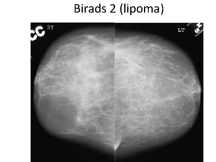 Birads 2 (lipoma) 