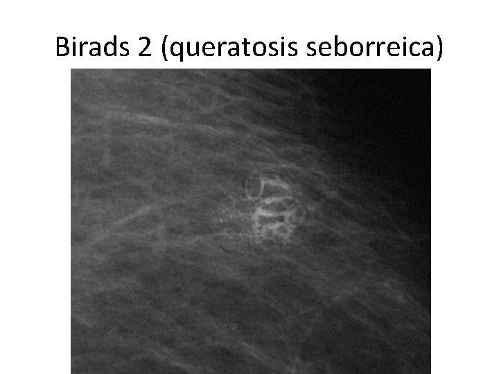 Birads 2 (queratosis seborreica) 