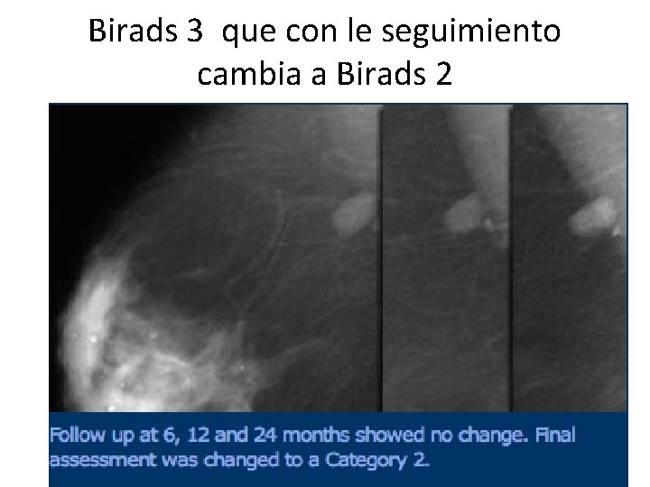 Birads 3 que con le seguimiento cambia a Birads 2 