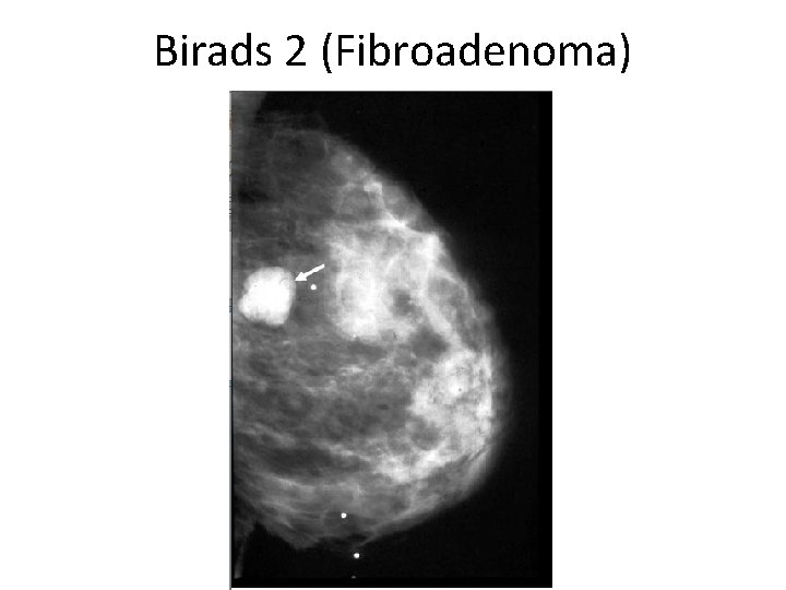 Birads 2 (Fibroadenoma) 