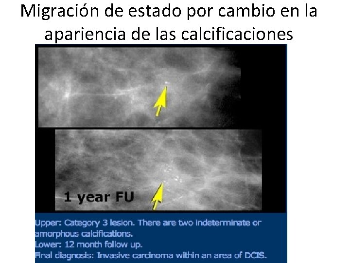 Migración de estado por cambio en la apariencia de las calcificaciones 