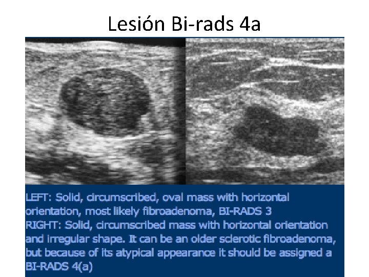 Lesión Bi-rads 4 a 