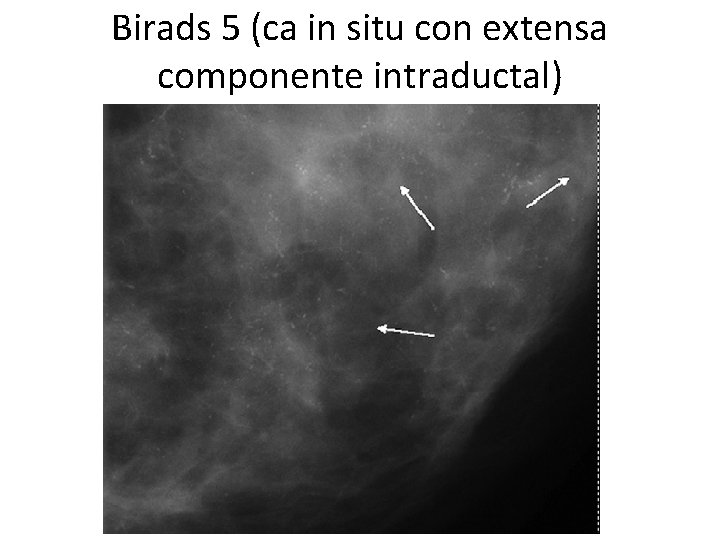 Birads 5 (ca in situ con extensa componente intraductal) 