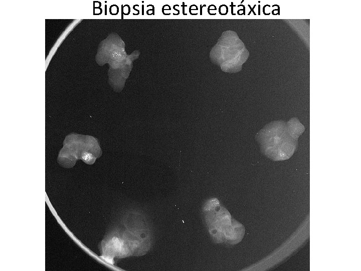 Biopsia estereotáxica 