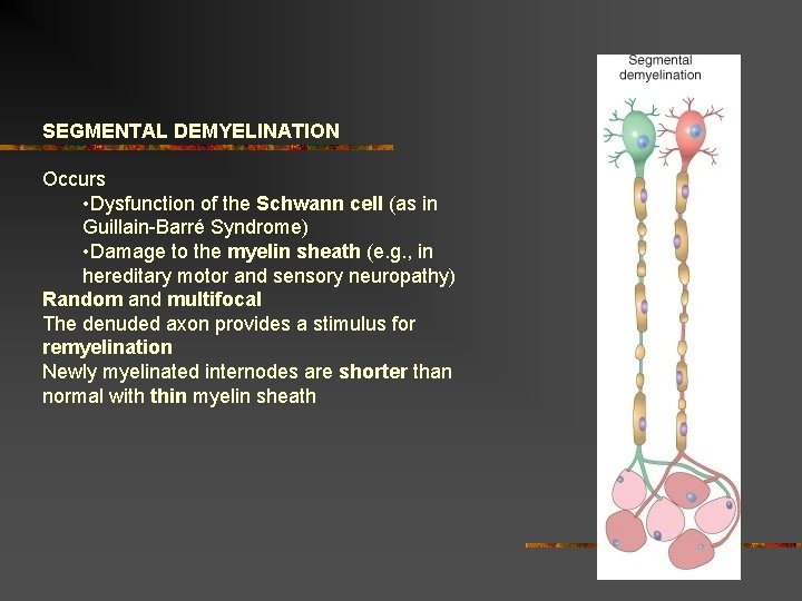SEGMENTAL DEMYELINATION Occurs • Dysfunction of the Schwann cell (as in Guillain-Barré Syndrome) • SEGMENTAL DEMYELINATION Occurs • Dysfunction of the Schwann cell (as in Guillain-Barré Syndrome) •