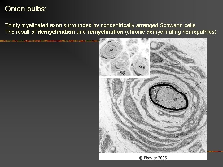 Onion bulbs: Thinly myelinated axon surrounded by concentrically arranged Schwann cells The result of Onion bulbs: Thinly myelinated axon surrounded by concentrically arranged Schwann cells The result of