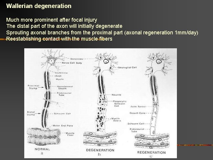 Wallerian degeneration Much more prominent after focal injury The distal part of the axon Wallerian degeneration Much more prominent after focal injury The distal part of the axon