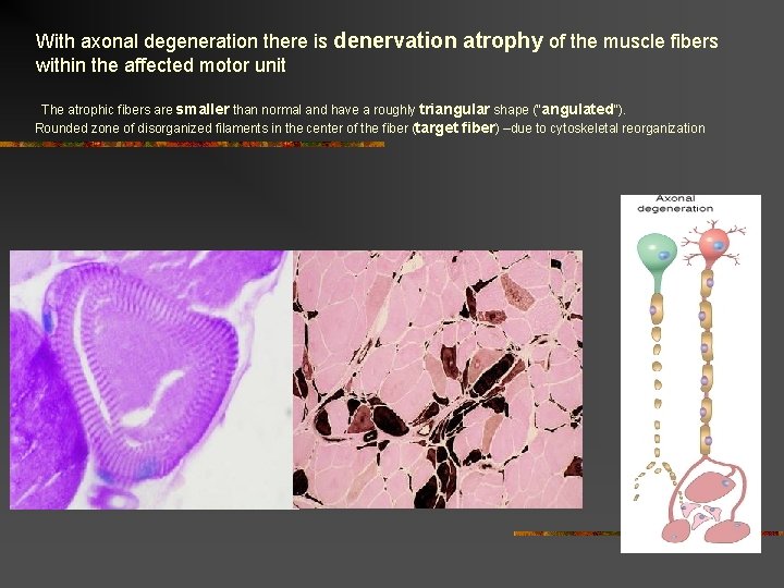 With axonal degeneration there is denervation atrophy of the muscle fibers within the affected With axonal degeneration there is denervation atrophy of the muscle fibers within the affected