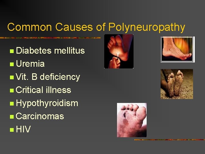 Common Causes of Polyneuropathy n Diabetes mellitus n Uremia n Vit. B deficiency n Common Causes of Polyneuropathy n Diabetes mellitus n Uremia n Vit. B deficiency n