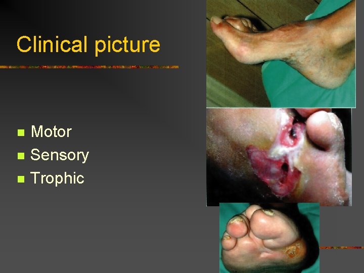Clinical picture n n n Motor Sensory Trophic  Clinical picture n n n Motor Sensory Trophic