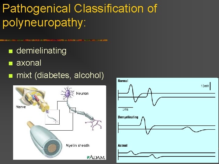 Pathogenical Classification of polyneuropathy: n n n demielinating axonal mixt (diabetes, alcohol)  Pathogenical Classification of polyneuropathy: n n n demielinating axonal mixt (diabetes, alcohol)