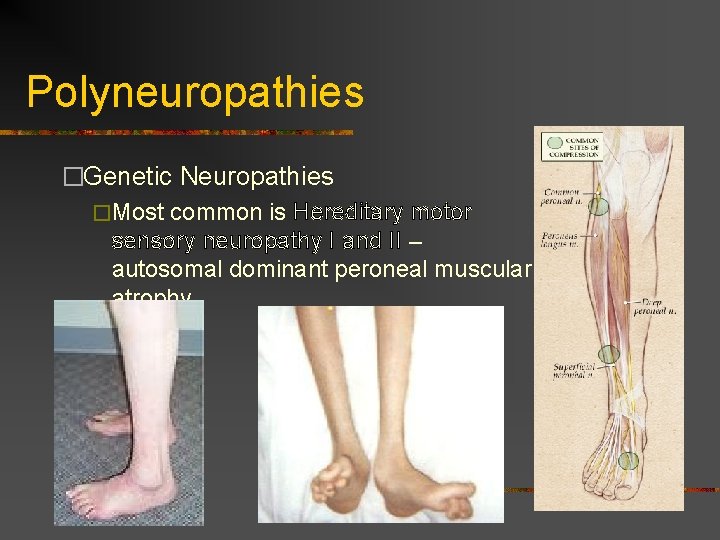 Polyneuropathies �Genetic Neuropathies �Most common is Hereditary motor sensory neuropathy I and II – Polyneuropathies �Genetic Neuropathies �Most common is Hereditary motor sensory neuropathy I and II –