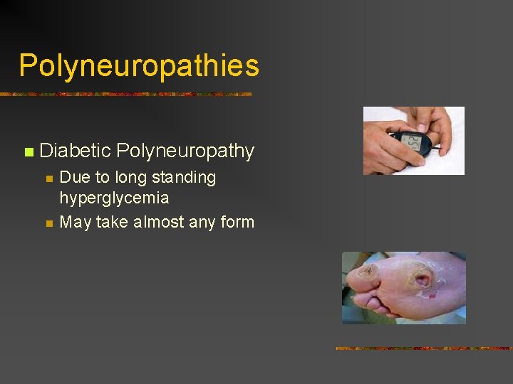 Polyneuropathies n Diabetic Polyneuropathy n n Due to long standing hyperglycemia May take almost Polyneuropathies n Diabetic Polyneuropathy n n Due to long standing hyperglycemia May take almost