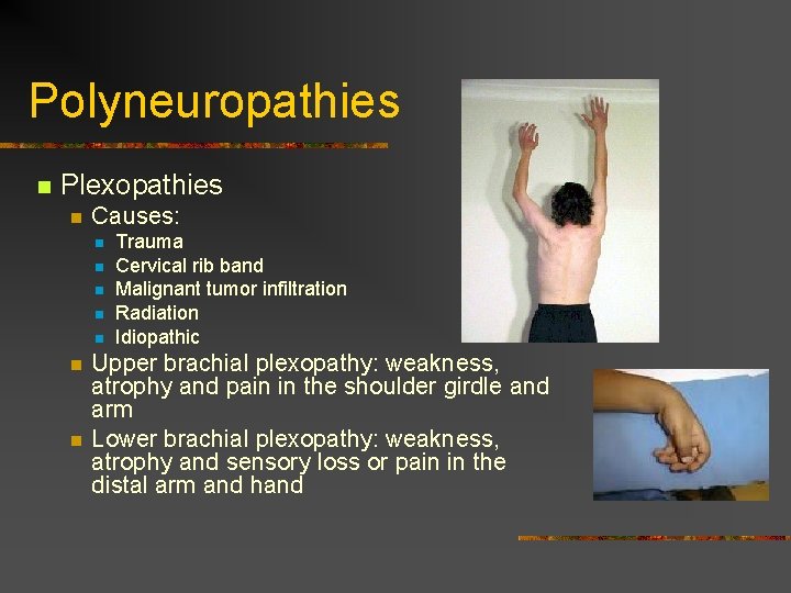 Polyneuropathies n Plexopathies n Causes: n n n n Trauma Cervical rib band Malignant Polyneuropathies n Plexopathies n Causes: n n n n Trauma Cervical rib band Malignant