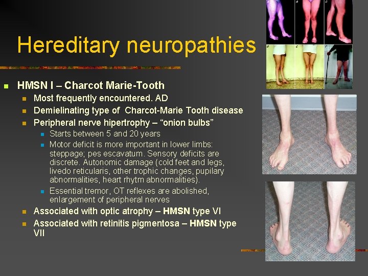 Hereditary neuropathies n HMSN I – Charcot Marie-Tooth n n n Most frequently encountered. Hereditary neuropathies n HMSN I – Charcot Marie-Tooth n n n Most frequently encountered.