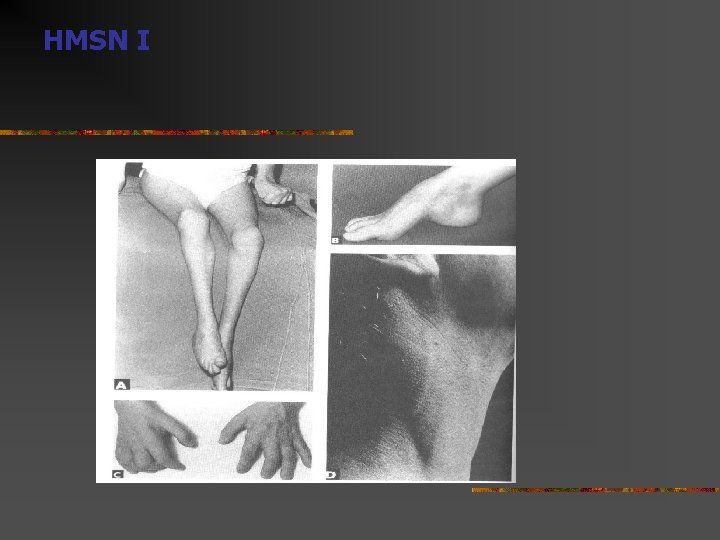 HMSN I  HMSN I