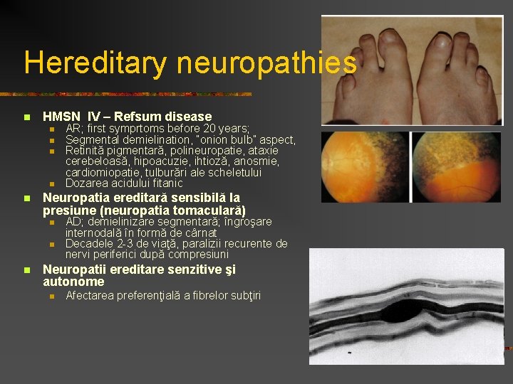 Hereditary neuropathies n HMSN IV – Refsum disease n n n Neuropatia ereditară sensibilă Hereditary neuropathies n HMSN IV – Refsum disease n n n Neuropatia ereditară sensibilă