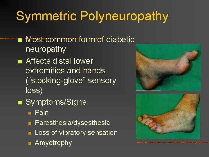 Symmetric Polyneuropathy n n n Most common form of diabetic neuropathy Affects distal lower Symmetric Polyneuropathy n n n Most common form of diabetic neuropathy Affects distal lower
