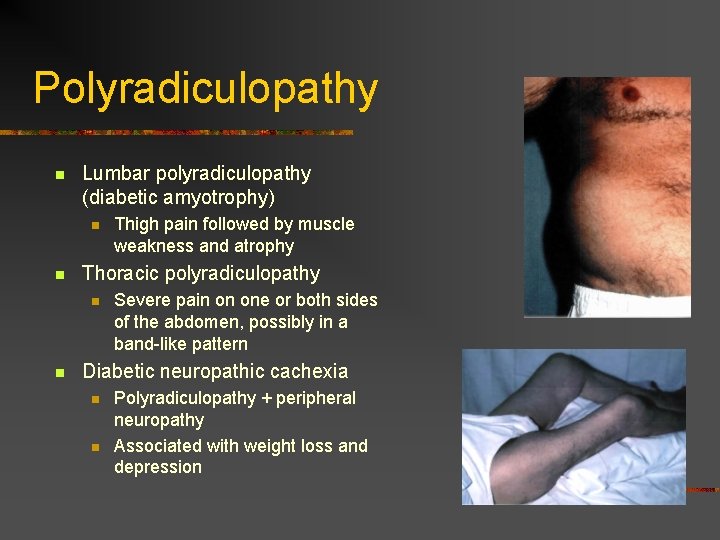 Polyradiculopathy n Lumbar polyradiculopathy (diabetic amyotrophy) n n Thoracic polyradiculopathy n n Thigh pain Polyradiculopathy n Lumbar polyradiculopathy (diabetic amyotrophy) n n Thoracic polyradiculopathy n n Thigh pain