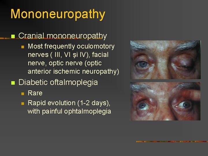 Mononeuropathy n Cranial mononeuropathy n n Most frequently oculomotory nerves ( III, VI şi Mononeuropathy n Cranial mononeuropathy n n Most frequently oculomotory nerves ( III, VI şi