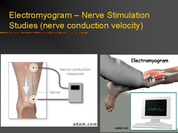 Electromyogram – Nerve Stimulation Studies (nerve conduction velocity)  Electromyogram – Nerve Stimulation Studies (nerve conduction velocity)
