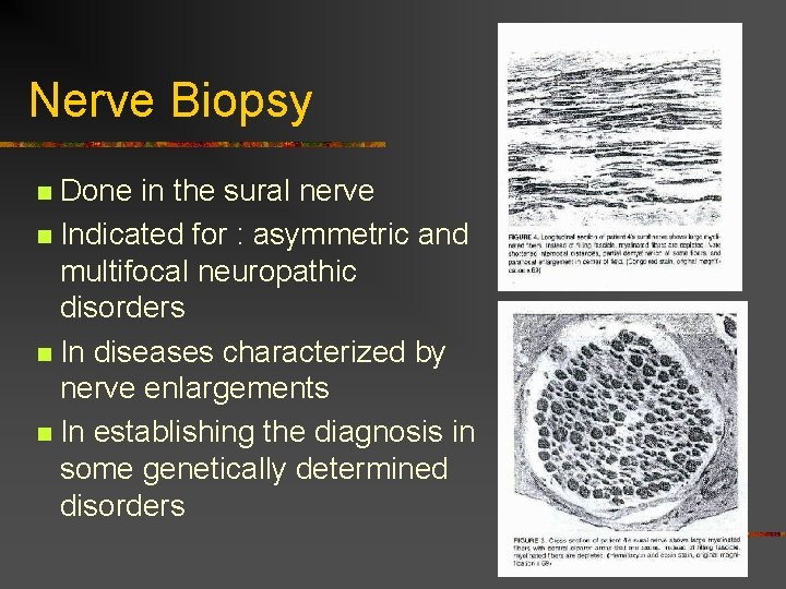 Nerve Biopsy Done in the sural nerve n Indicated for : asymmetric and multifocal Nerve Biopsy Done in the sural nerve n Indicated for : asymmetric and multifocal