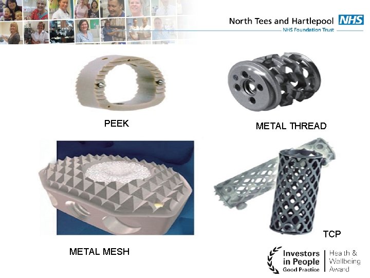 PEEK METAL THREAD TCP METAL MESH 