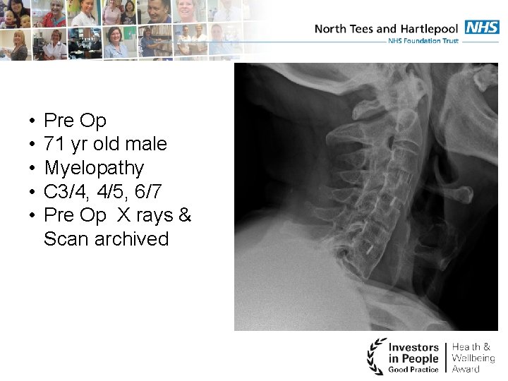  • • • Pre Op 71 yr old male Myelopathy C 3/4, 4/5,