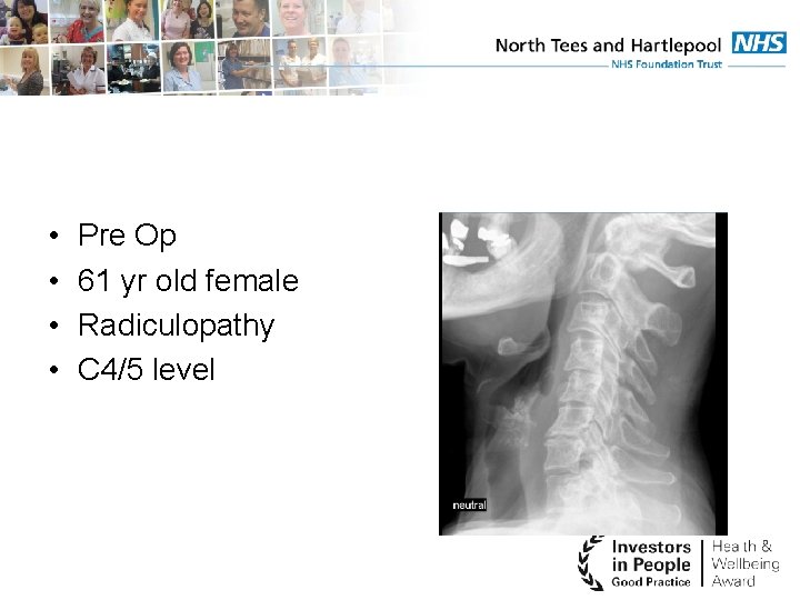  • • Pre Op 61 yr old female Radiculopathy C 4/5 level 