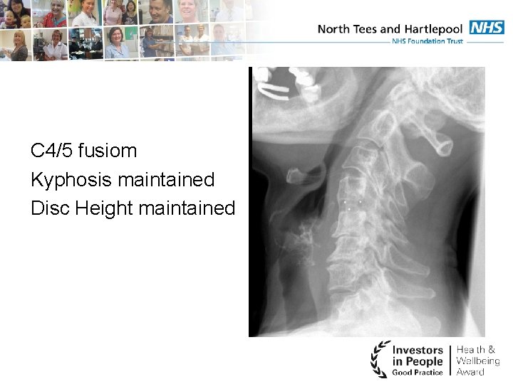 C 4/5 fusiom Kyphosis maintained Disc Height maintained 