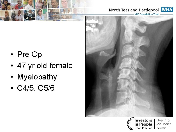  • • Pre Op 47 yr old female Myelopathy C 4/5, C 5/6