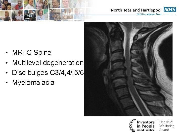  • • MRI C Spine Multilevel degeneration Disc bulges C 3/4, 4/, 5/6