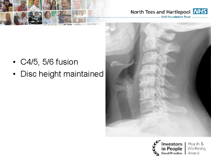  • C 4/5, 5/6 fusion • Disc height maintained 
