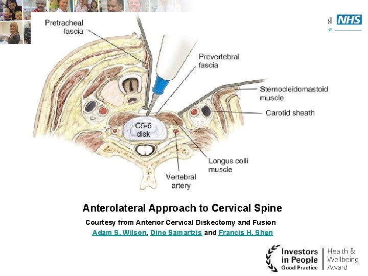 Anterolateral Approach to Cervical Spine Courtesy from Anterior Cervical Diskectomy and Fusion Adam S.