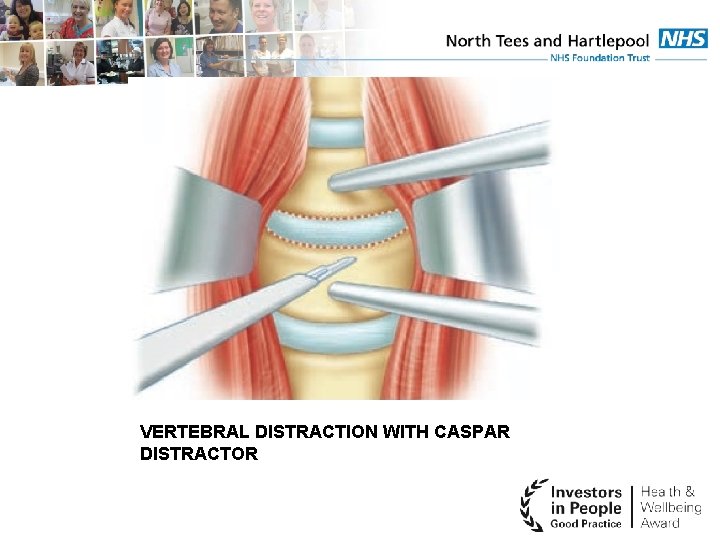 VERTEBRAL DISTRACTION WITH CASPAR DISTRACTOR 