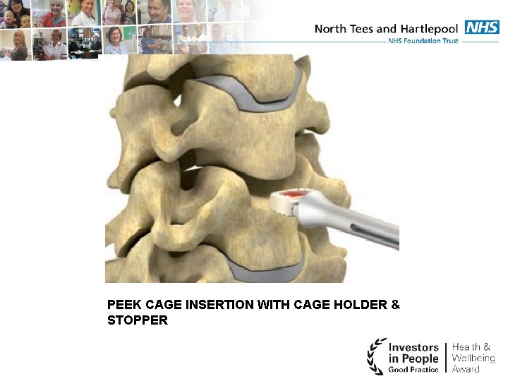PEEK CAGE INSERTION WITH CAGE HOLDER & STOPPER 